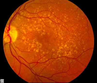 Fundus photograph showing intermediate age-related macular degeneration