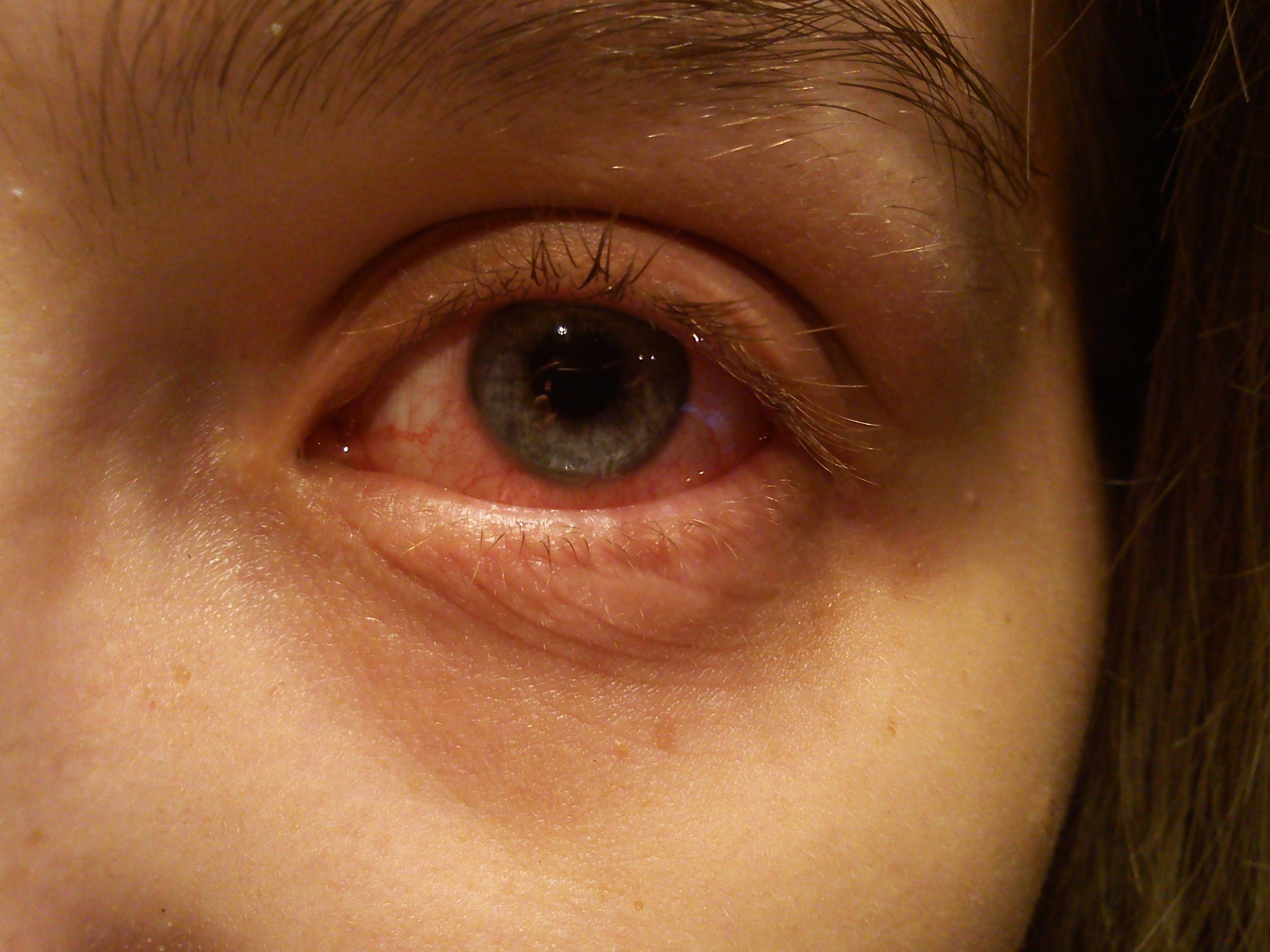 Photograph of an eye with conjunctivitis