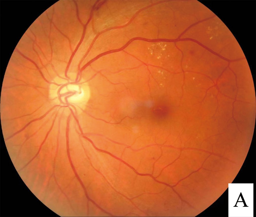 Fundus photograph showing signs of diabetic retinopathy
